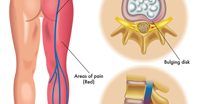 Sciatic Nerve Pain image